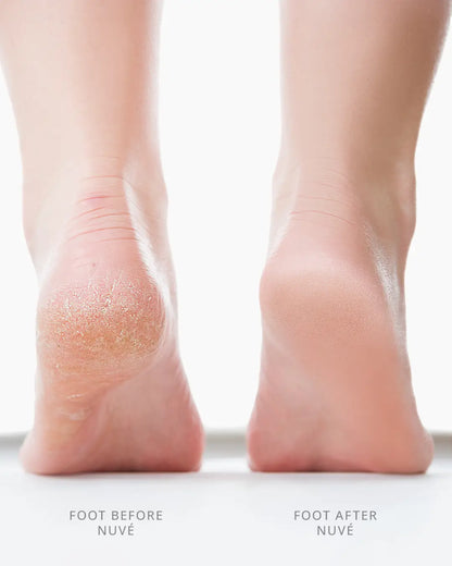 Electric Foot File Callus Remover 3 Pro